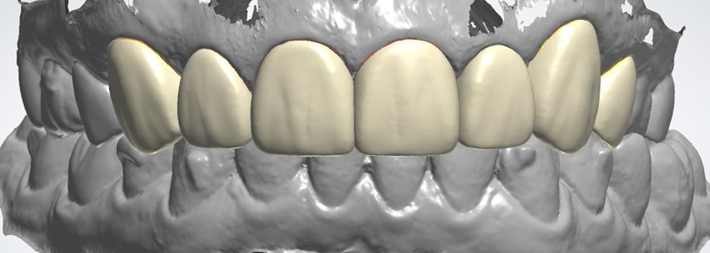 Veneers & Smile Design